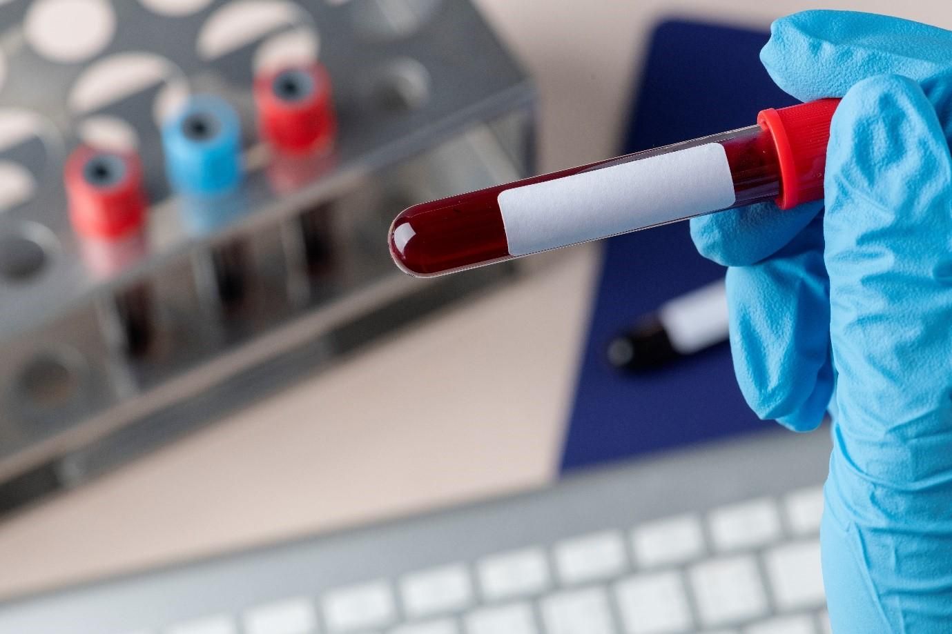 How Esr Test Helps In Early Detection Of Inflammatory Disorders