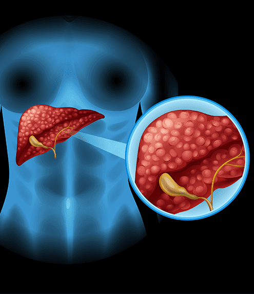 Cirrhosis And Autoimmune Liver Diseases