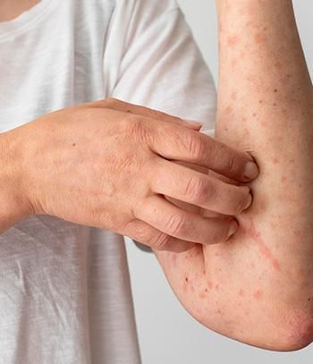 Food Allergies How To Diagnose