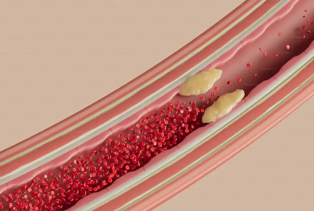VLDL Cholesterol: Symptoms, Causes & Levels