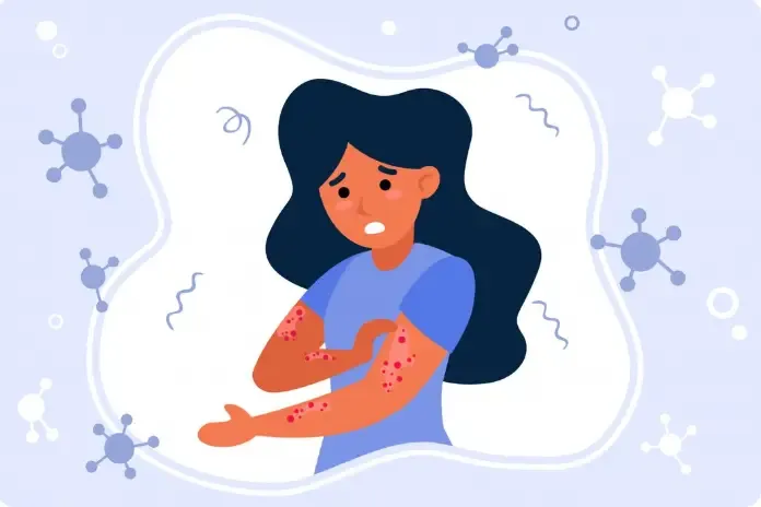 What is Chickenpox? Stages and Prevention Tips