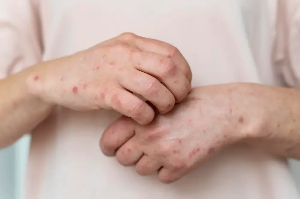 Chickenpox – Symptoms, Causes and Risk Factors