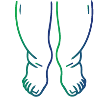 Swelling in the legs and ankles