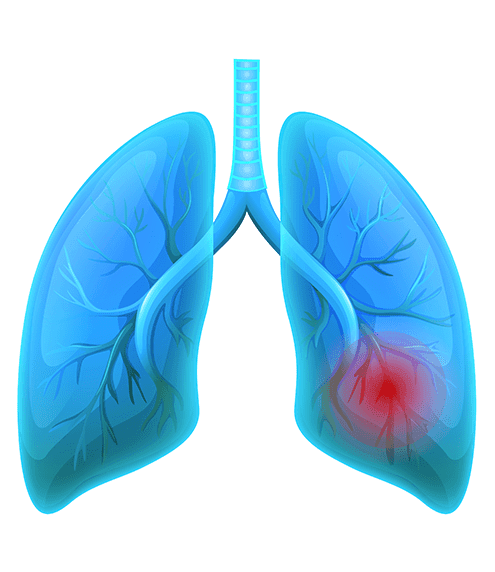 Understanding Hypersensitivity Pneumonitis Hp