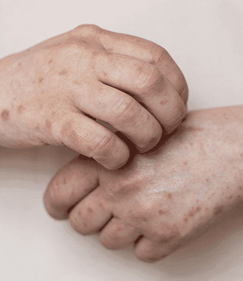 Lupus Anticoagulant Test