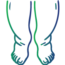 Edema