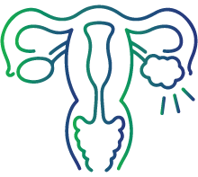 Polycystic Ovary Syndrome (PCOS)