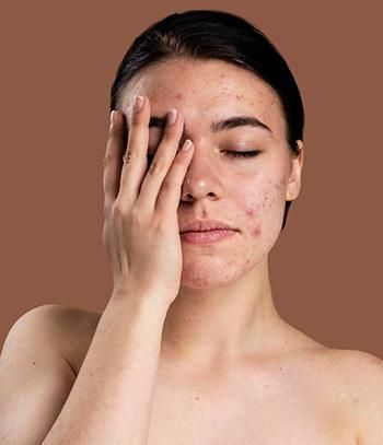 Pcos Things To Know
