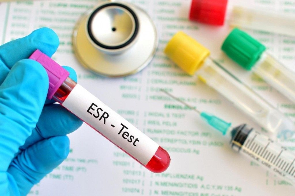 What Does a High ESR Test Mean? Causes of Elevated ESR and When You Should Be Concerned