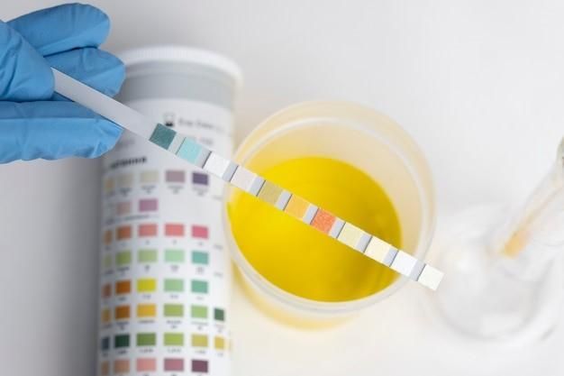 The Role Of Urine Tests In Diagnosing Kidney And Bladder Issues