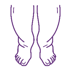 Swollen limbs