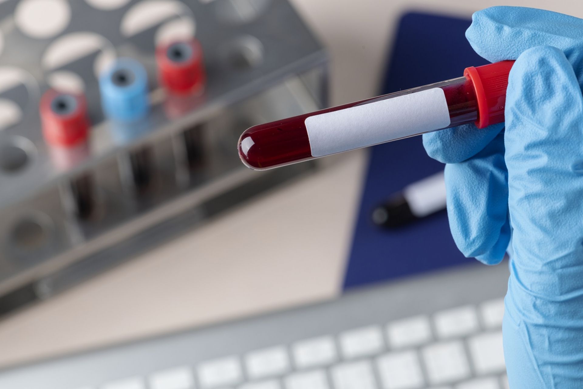 Understanding The Tests Included In Lupikavach Vitamin Test