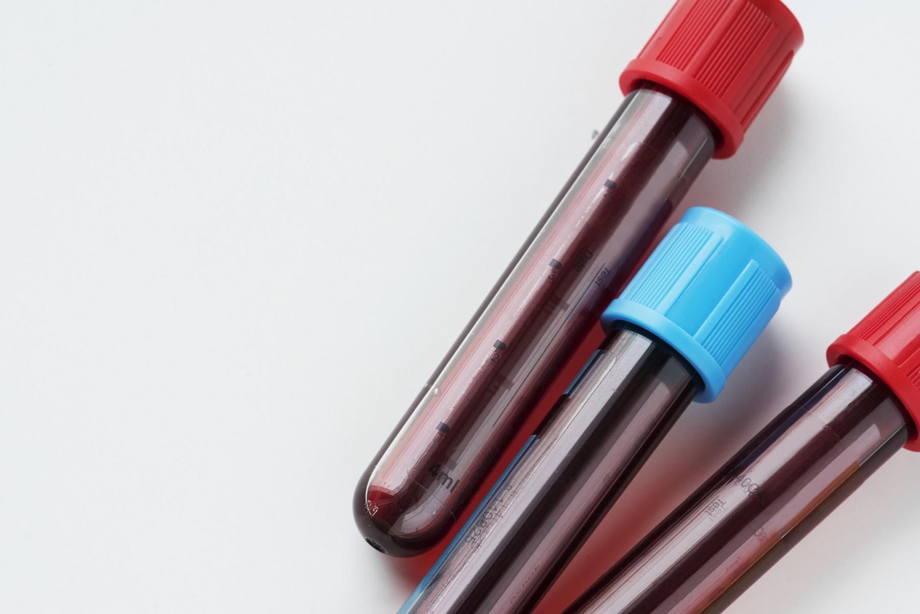 Urea Nitrogen Test Symptoms Causes And When To Get Tested